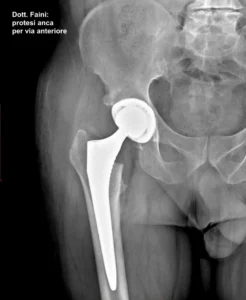 RX protesi d’anca con accesso anteriore mini-invasivo: tecnica avanzata per la sostituzione dell’articolazione