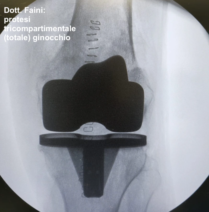 Protesi ginocchio tricompartimentale per il trattamento dell'artrosi avanzata