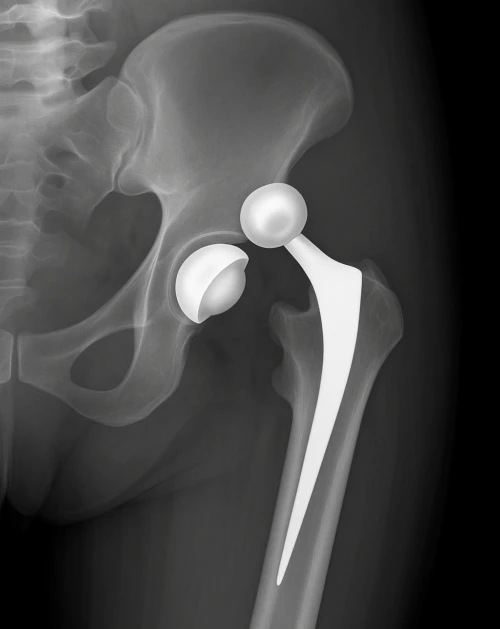 Radiografia che mostra la lussazione di una protesi totale d’anca, con testa femorale artificiale fuori dalla cavità acetabolare.