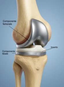 Illustrazione 3D dell’intervento di protesi ginocchio con componenti femorale, tibiale e inserto in polietilene.