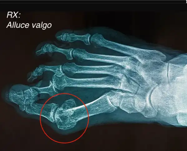 alluce-valgo-rx