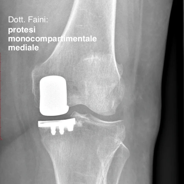 Protesi monocompartimentale mediale del ginocchio – Dr. Andrea Faini