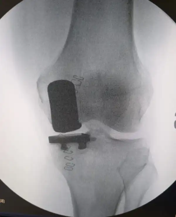 Protesi monocompartimentale mediale del ginocchio – Dr. Andrea Faini