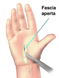 fascia palmare aperta