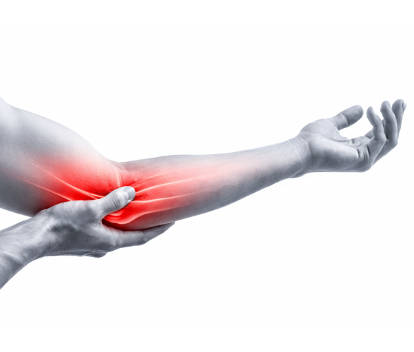 Sindrome del tunnel cubitale con dolore al gomito e irritazione del nervo ulnare