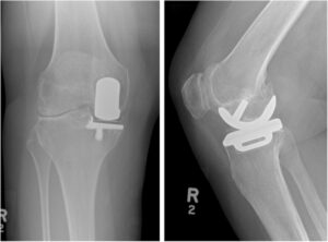 Radiografia AP e laterale del ginocchio destro con protesi monocompartimentale mediale (UKA).